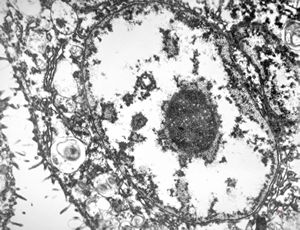 M, | cytomegalovirus - pneumonia